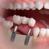 Dental-Implants-London-Ontario-London-Dentist-Stoney-Family-Dental-600x600.jpg