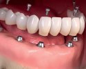 Full-denture-implants.jpg
